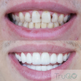 Truglo patient Before and after images of teeth of a certain teeth procedure