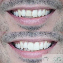 Truglo patient Before and after images of teeth of a certain teeth procedure