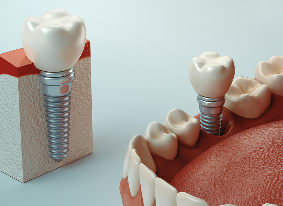 A 3d image of a dental implant and an implant being set inside a mouth