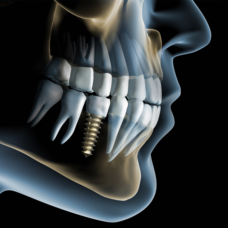 A skeletol image of a dental part with an implant inside it
