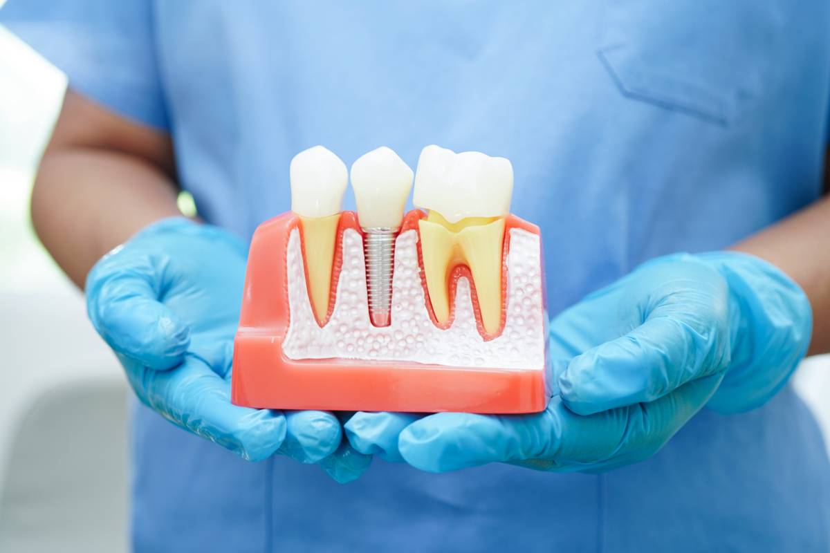 featured image for article about pros and cons of dental implants