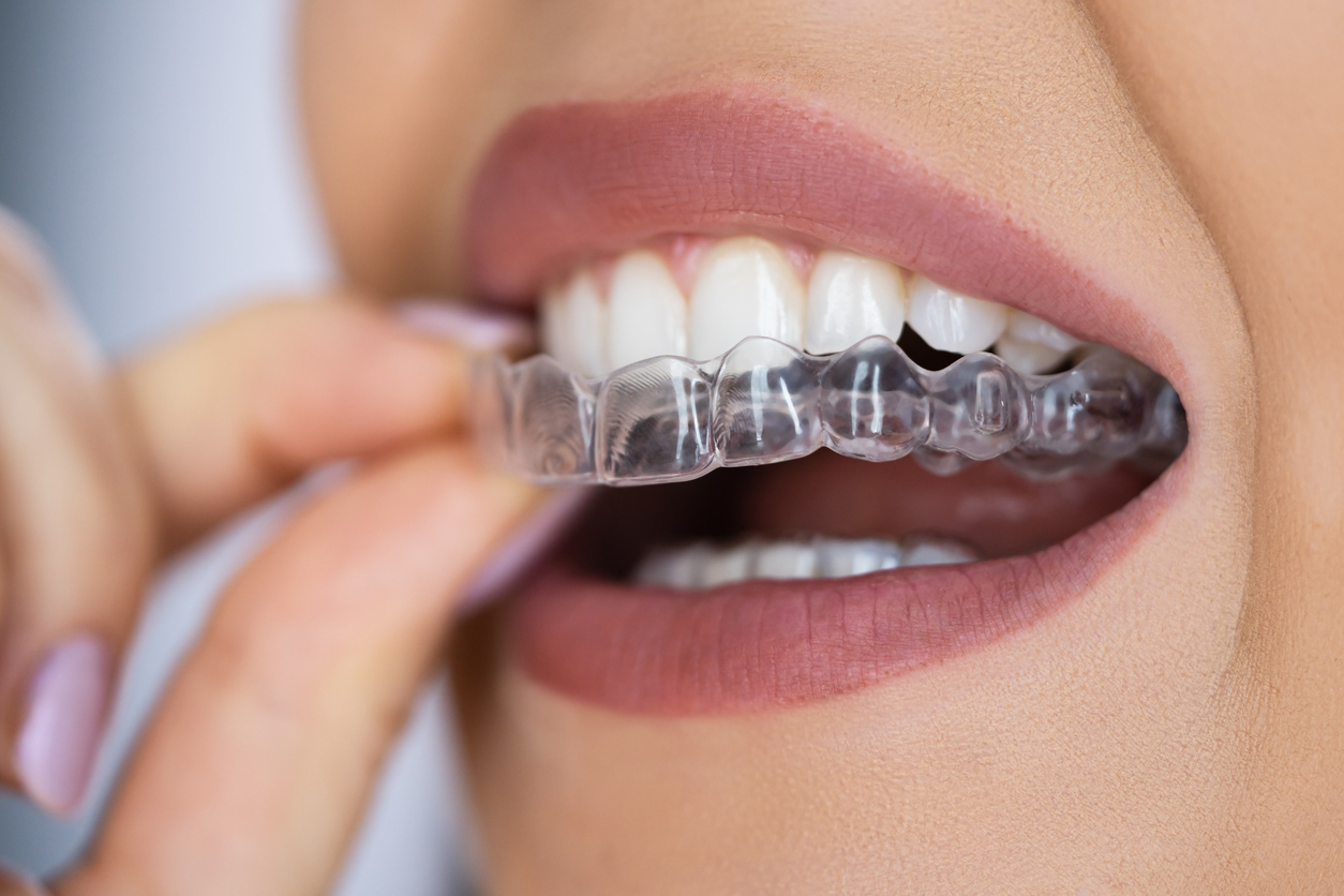 Closeup image of smiling face wearing clear aligners to ask how does invisalign differ from other orthodontic treatments.