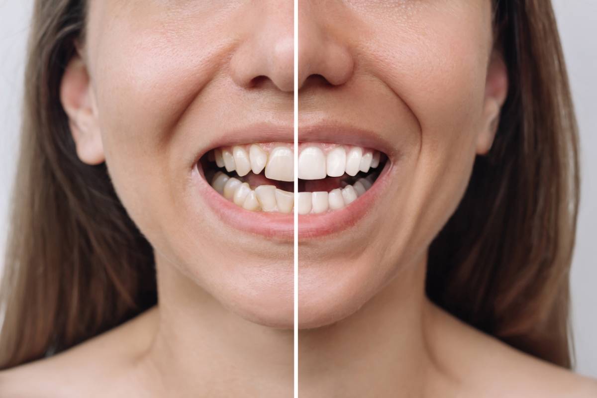 Featured image for What Do Teeth Look Like Under Veneers