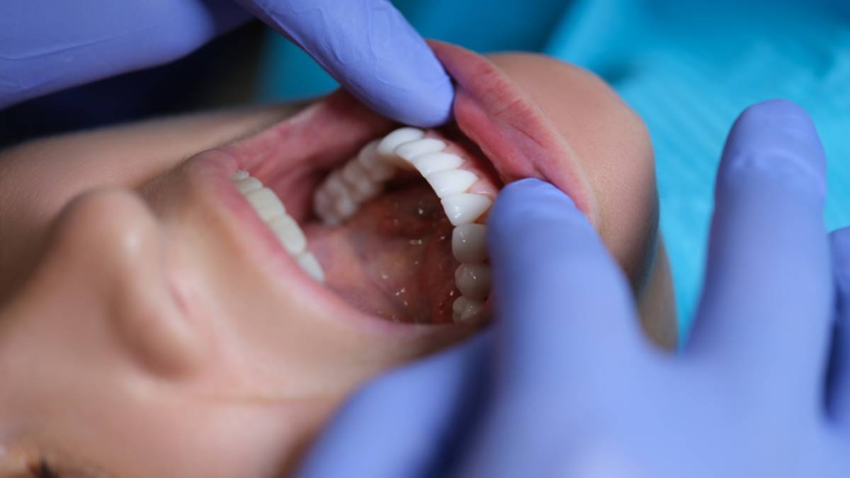 Doctor dentist examining patient oral cavity with veneers closeup.